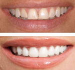 dental teeth bonding 700x656 newxjpg 1770747332 150x141